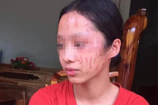 Nữ sinh cào nhau nát mặt, hai gia đình tự giảng hòa