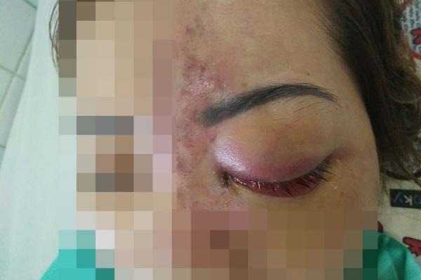 Tiêm filler độn trán, cô gái bị biến chứng đáng sợ-1