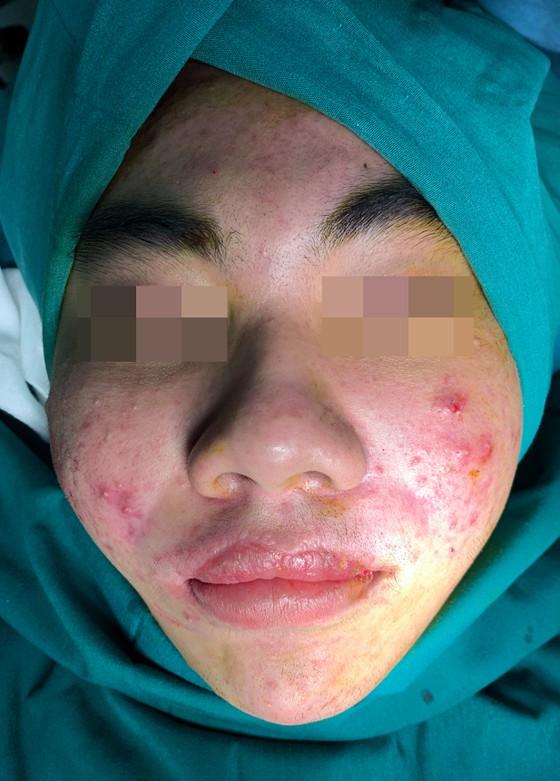 Tiêm filler độn trán, cô gái bị biến chứng đáng sợ-2