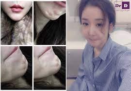 Tiêm filler độn trán, cô gái bị biến chứng đáng sợ-4