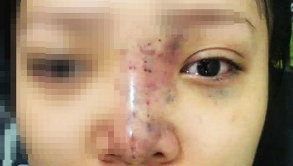 Tiêm filler độn trán, cô gái bị biến chứng đáng sợ-3