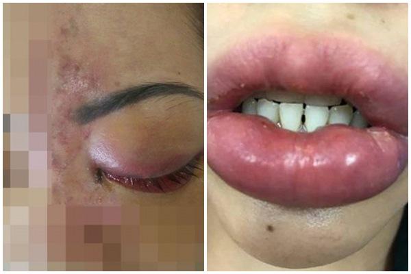 Cô gái 25 tuổi bị hoại tử vùng mũi, trán sau khi tiêm filler làm đẹp-2