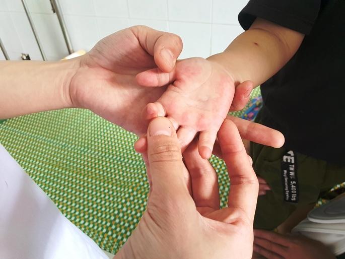 Bệnh tay chân miệng bùng phát mạnh ở Quảng Nam, Quảng Ngãi-2
