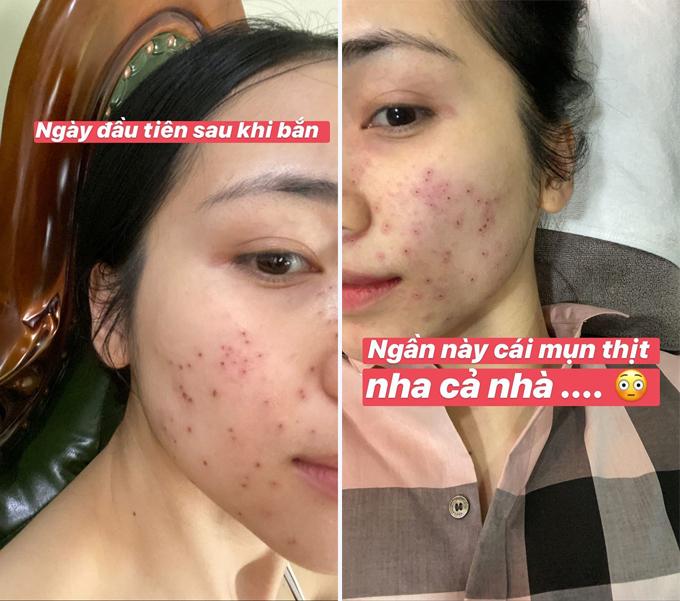 Linh Chi tự tin khoe gò má chi chít mụn thịt-5