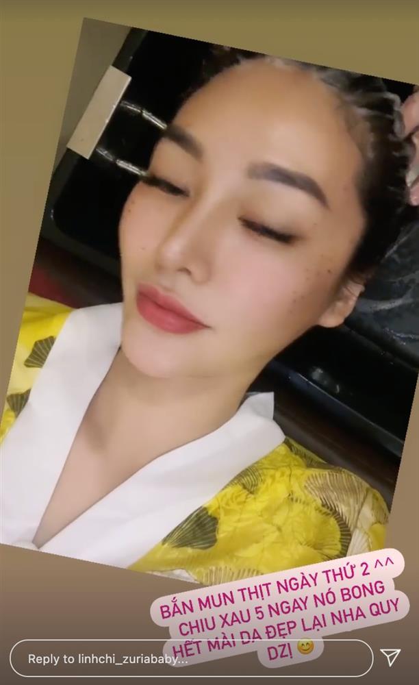 Linh Chi tự tin khoe gò má chi chít mụn thịt-2