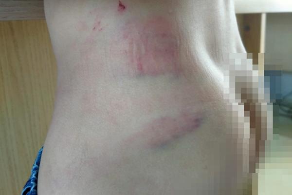 Bố ép con trai về ở cùng mẹ kế, rồi đánh con nhập viện-2