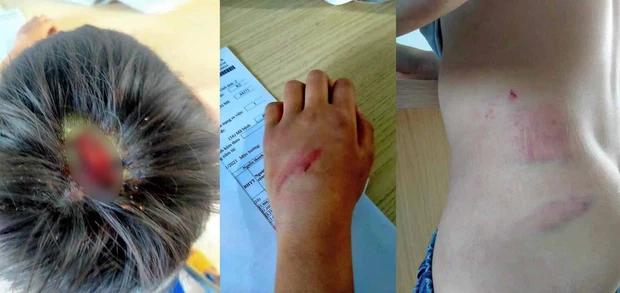 Bố ép con trai về ở cùng mẹ kế, rồi đánh con nhập viện-1