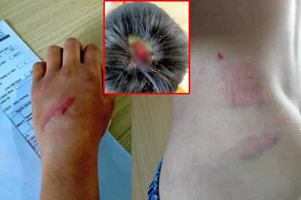 Bé trai bị dượng quăng xuống nền xi măng, châm thuốc lá đang cháy vào mặt-2