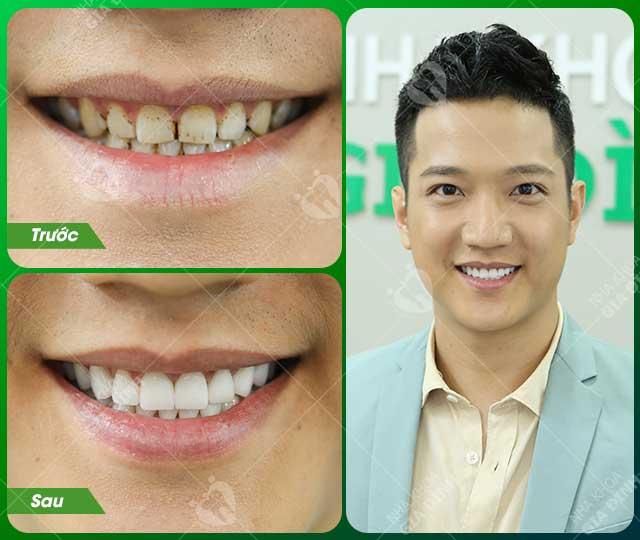 Cô gái mủn răng đến nỗi phải ghép xương sau khi lắp răng sứ-3