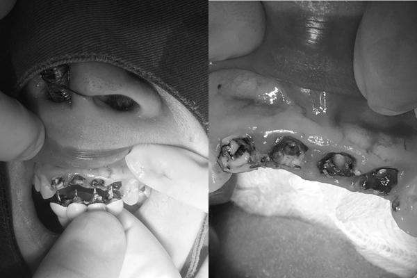 Cô gái mủn răng đến nỗi phải ghép xương sau khi lắp răng sứ-1