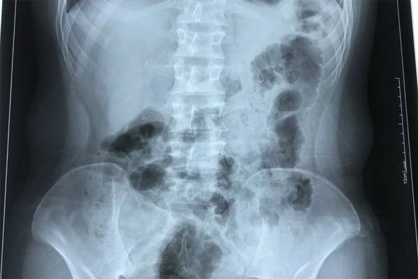 Chàng trai Hà Nội có trái tim bên phải, phủ tạng đảo ngược-1