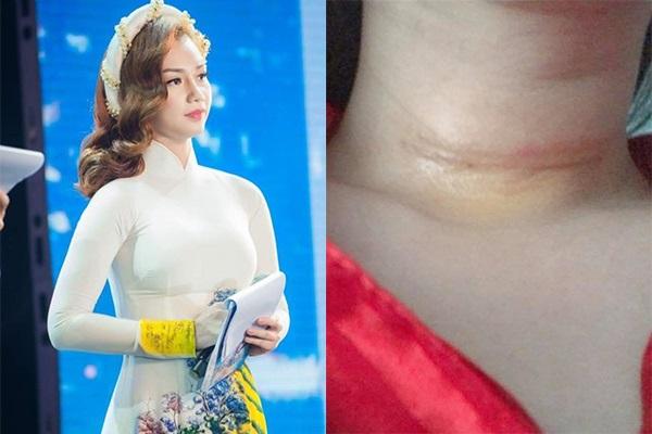 MC Quỳnh Chi khoe phụ kiện sẹo sau phẫu thuật ung thư tuyến giáp-5