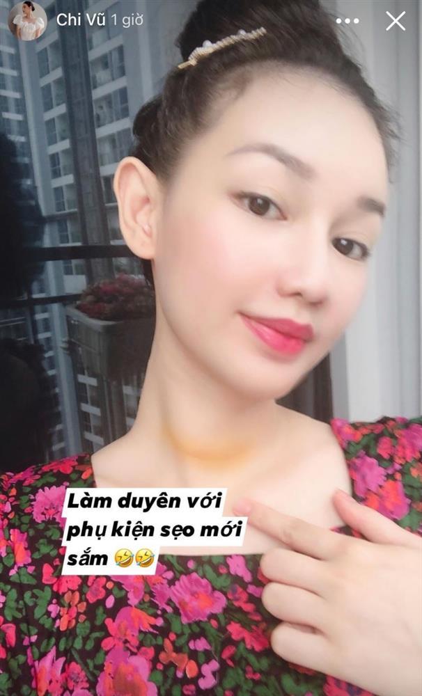 MC Quỳnh Chi khoe phụ kiện sẹo sau phẫu thuật ung thư tuyến giáp-1