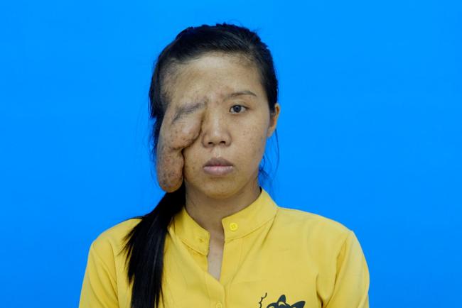 Mẹ đơn thân một mắt và 3 cuộc đại phẫu, phản ứng con gái gặp lại mẹ rớt nước mắt-3