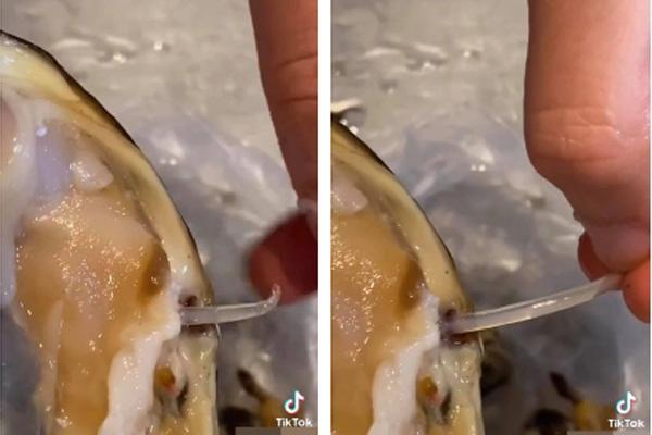 Gan lúc nhúc sán vì ăn quá nhiều gỏi hải sản tươi sống-3