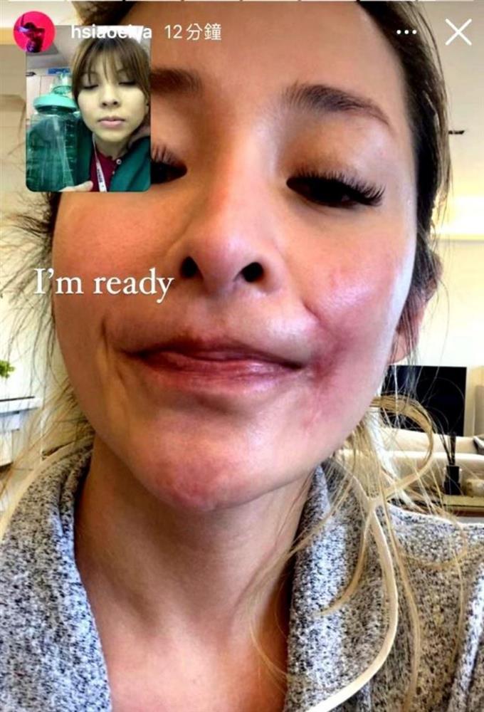 Tiêu Á Hiên công khai vết sẹo do chó cắn, tiết lộ mặt bị hoại tử-2