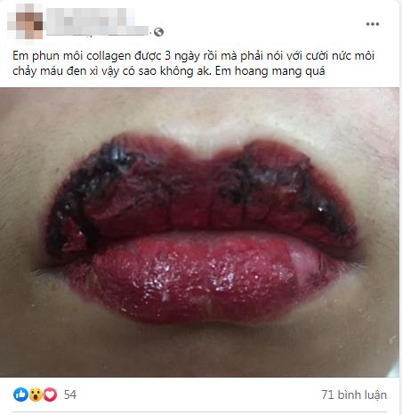 Phun môi collagen siêu hot, cô gái khóc ngất vì đôi môi khác gì bánh mì cháy-1