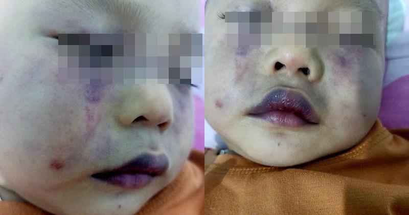 Cô giáo đánh bé 18 tháng tuổi thương tích, nhập viện vì quá hoảng sợ?-2