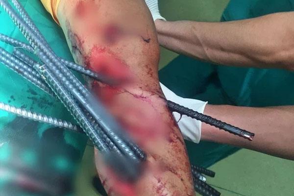 Kinh hoàng: Thanh niên bị 11 thanh sắt từ xe ba gác đâm xuyên chân-1