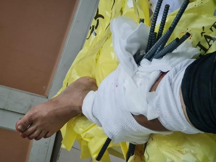 Kinh hoàng: Thanh niên bị 11 thanh sắt từ xe ba gác đâm xuyên chân-2