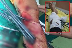 Kinh hoàng: Thanh niên bị 11 thanh sắt từ xe ba gác đâm xuyên chân