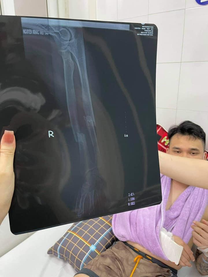 Tình hình sức khỏe Khắc Việt sau ca phẫu thuật-2