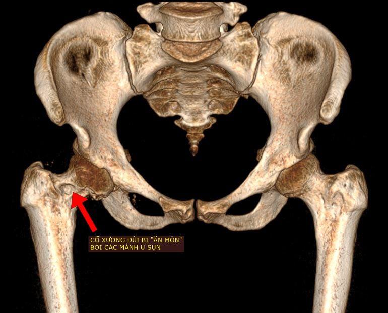 Rùng mình: Bác sĩ nội soi lấy hơn 50 viên sỏi trong khớp háng của người phụ nữ-1