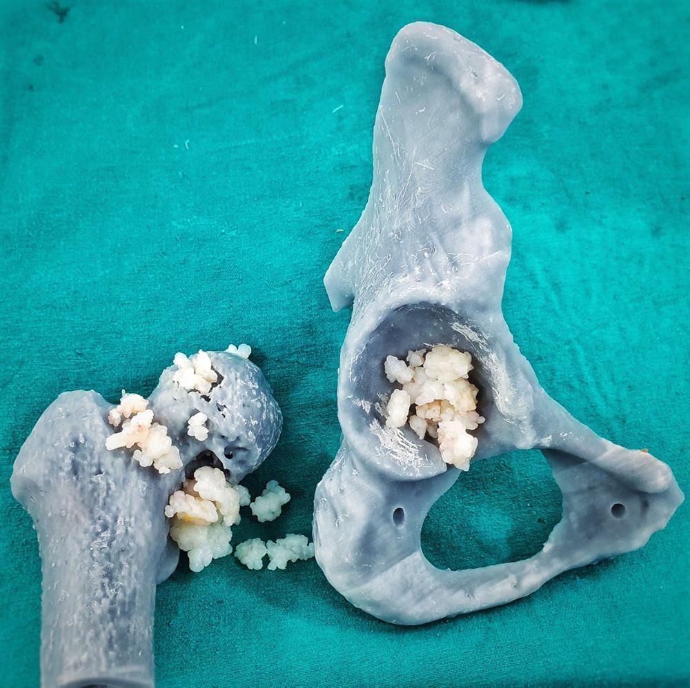 Rùng mình: Bác sĩ nội soi lấy hơn 50 viên sỏi trong khớp háng của người phụ nữ-3