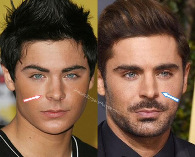Sốc: Zac Efron biến dạng xương mặt, lại là kết quả dao kéo quá đà?-4