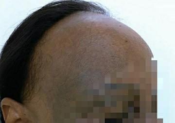 Người phụ nữ ở TP.HCM mắc bệnh hiếm khiến tóc rụng nửa đầu-1