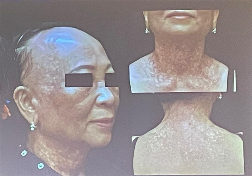 Người phụ nữ mắc bệnh lạ, nghi do ánh nắng mặt trời-1