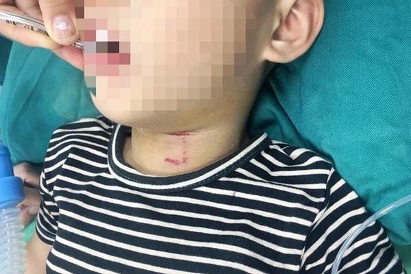 Nghệ An: Bé trai 3 tuổi bị chó cắn rách vùng cổ, thủng khí quản-1
