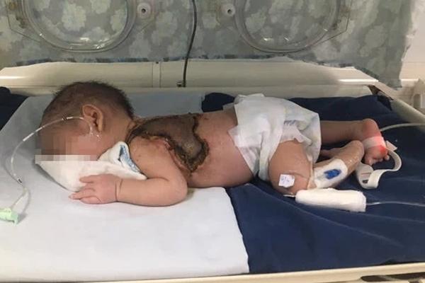 Dùng kim khâu chích mụn, bé trai 15 ngày tuổi nhiễm trùng huyết, hoại tử da-1