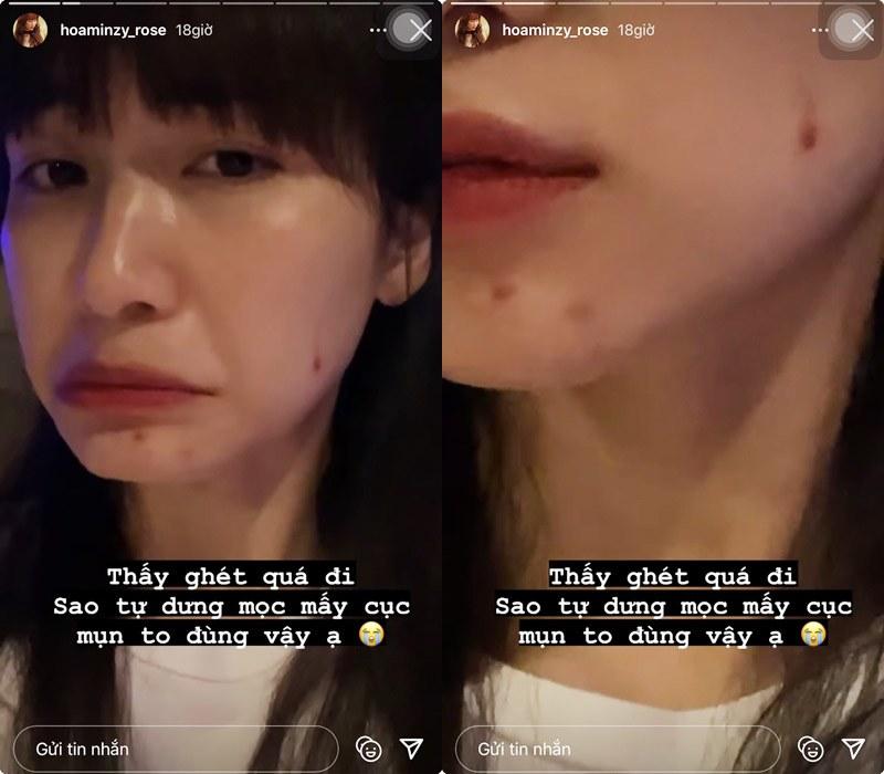 Hòa Minzy muốn trầm cảm vì da dẻ bong tróc thành từng mảng-3
