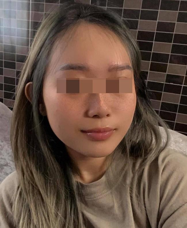 Hồi hộp xem review cấy hồng môi khử thâm, chuyên gia nói gì về phương pháp này?-2