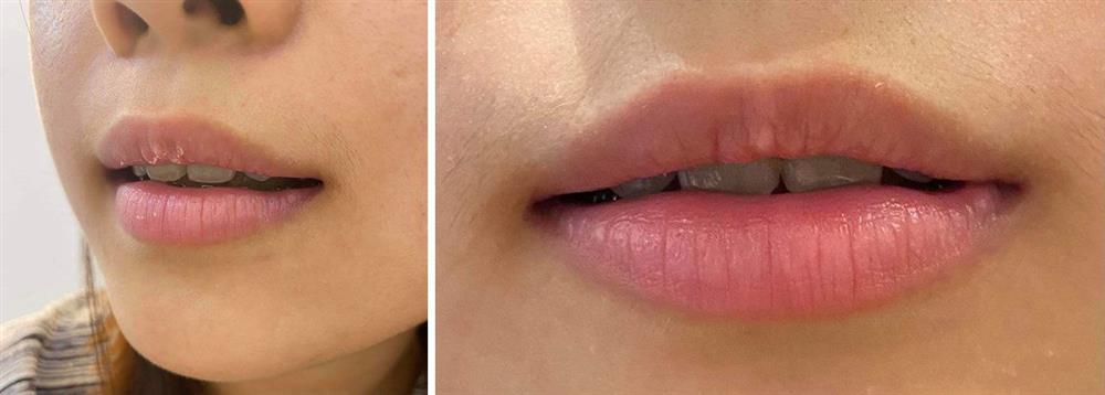 Hồi hộp xem review cấy hồng môi khử thâm, chuyên gia nói gì về phương pháp này?-9