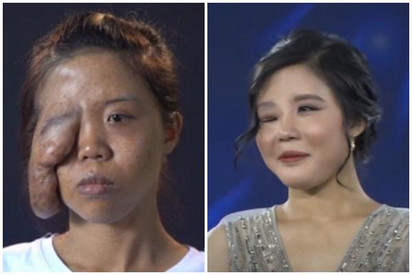 Chàng trai ngốn 60 triệu phẫu thuật, nào ngờ biến hình thành Trần Đức Bo-12