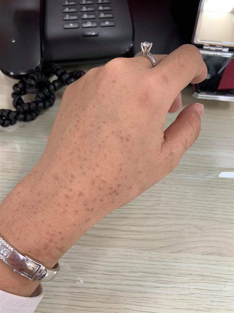 Cô gái bị loang lổ da tay như bà già sau chuyến du lịch, ai nhìn cũng hốt-2