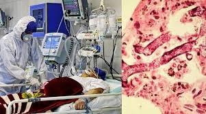 Ác mộng mới ở Ấn Độ: Bệnh nhân vừa khỏi Covid-19 thì tử vong vì loại virus khác-1