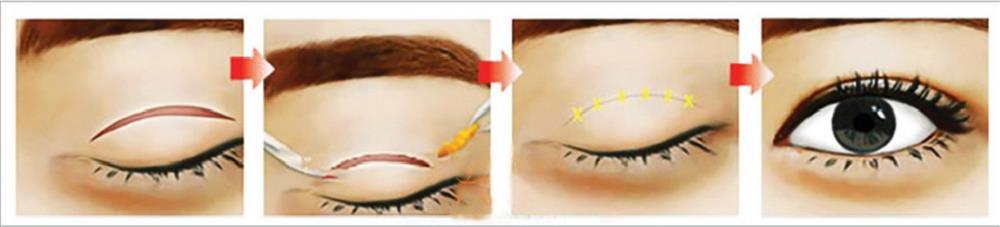 Thảm họa cắt mí: Cô gái 5 lần phẫu thuật vì mắt con đậu con bay-1