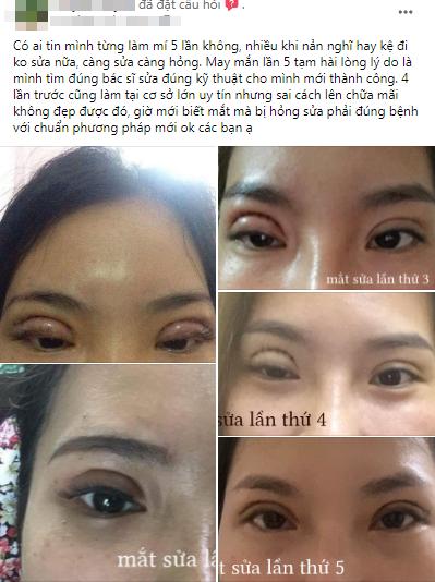 Thảm họa cắt mí: Cô gái 5 lần phẫu thuật vì mắt con đậu con bay-2