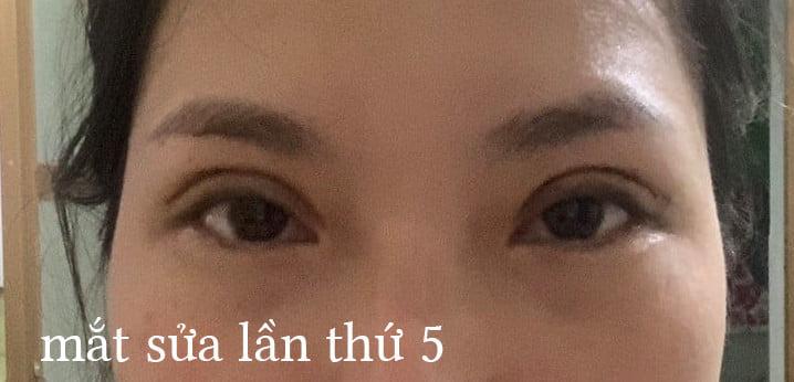 Thảm họa cắt mí: Cô gái 5 lần phẫu thuật vì mắt con đậu con bay-5