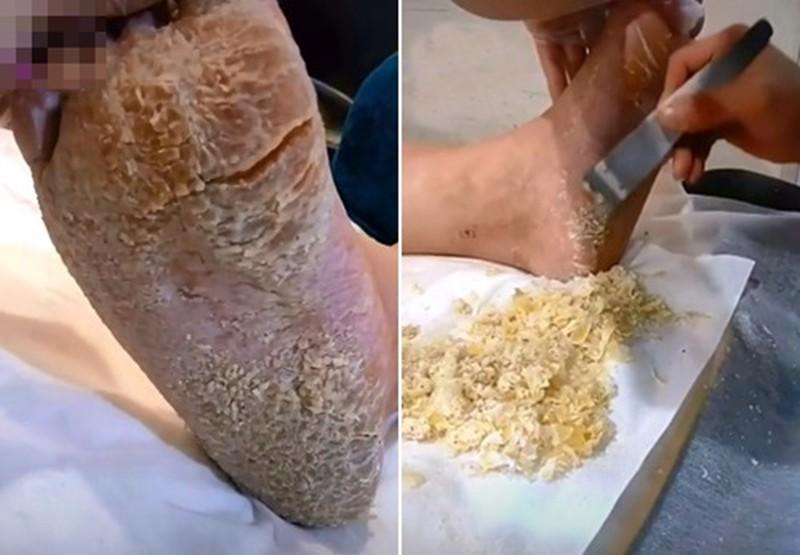 Rùng mình bàn chân như đất hạn hán và pha gọt da chết rơi lả tả-3