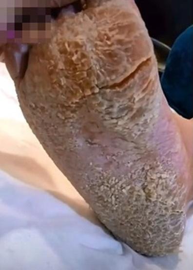 Rùng mình bàn chân như đất hạn hán và pha gọt da chết rơi lả tả-1