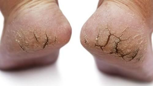 Rùng mình bàn chân như đất hạn hán và pha gọt da chết rơi lả tả-4
