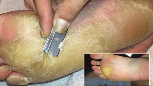 Rùng mình bàn chân như đất hạn hán và pha gọt da chết rơi lả tả-5