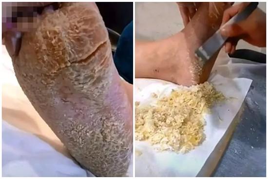 Rùng mình bàn chân như 'đất hạn hán' và pha gọt da chết rơi lả tả