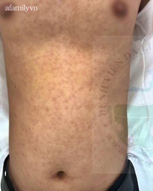 Quan hệ tình dục vô độ, nam thanh niên mắc cả bệnh giang mai lẫn hột xoài-1