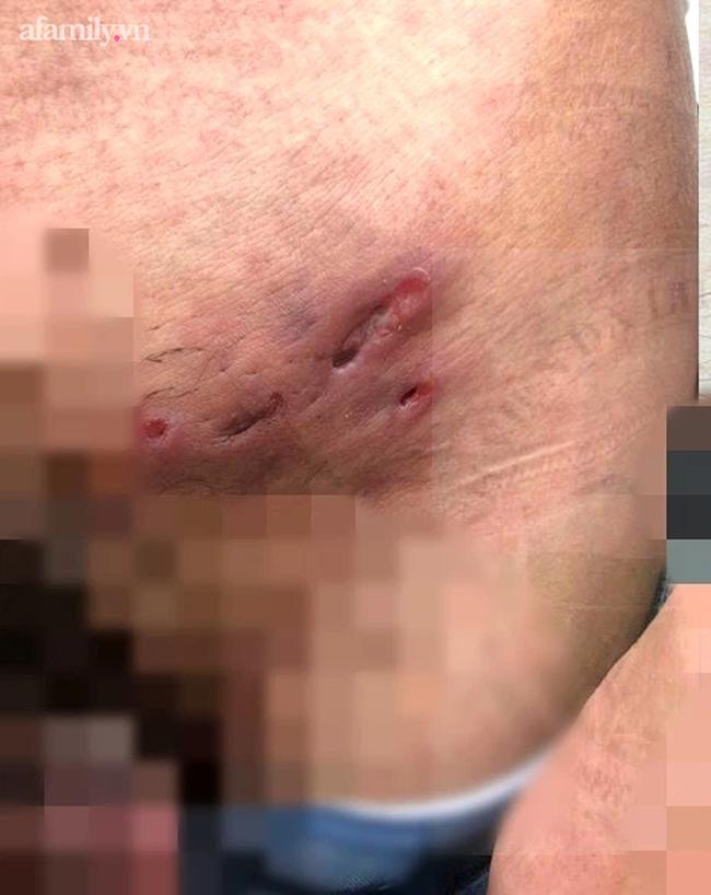 Quan hệ tình dục vô độ, nam thanh niên mắc cả bệnh giang mai lẫn hột xoài-2