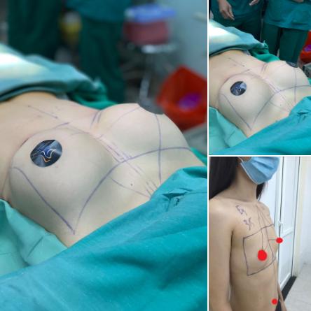 3 phương pháp trùng tu vòng 1 hot nhất hiện nay và những lưu ý quan trọng-1